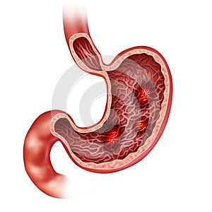 Stomach Ulcers photo
