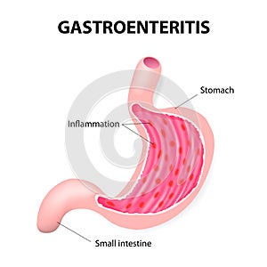 Stomach virus