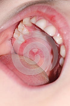 Stomatitis and herpes in the child mouth close-up