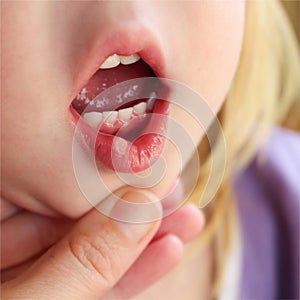 Stomatitis on lip in child photo