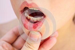 Stomatitis on the lip in child