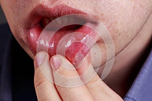 Stomatitis on the lips photo