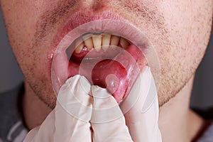 Stomatitis on the lips