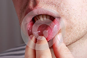 Stomatitis on the lips photo