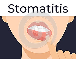 Stomatitis woman lips photo