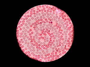 Stomatocytes in peripheral blood. Blood smear -Hematology.