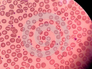 Stomatocytes in peripheral blood. Blood smear -Hematology.