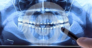 Stomatologist analysing dental radiography with braces