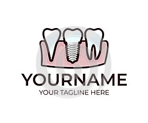 Stomatology, dental implant, denture and teeth, logo template. Medical, dental tooth, vector design. Dentistry