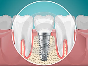 Ilustrace. zubní implantáty a zdravé zuby 