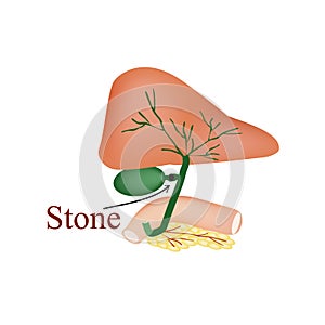 Stone bile duct. Gallbladder, duodenum, pancreas, bile ducts. Vector illustration on isolated background