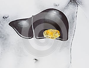 stone in the liver, schematic image, a large gallstone, the result of gallstones photo