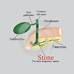 Stone pancreatic bile duct. The gall bladder, duodenum, bile ducts. Vector illustration on a gray background