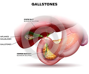 Stones in the Gallbladder and duct