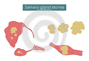 Stones in the parotid, submandibular and sublingual salivary glands and duct photo