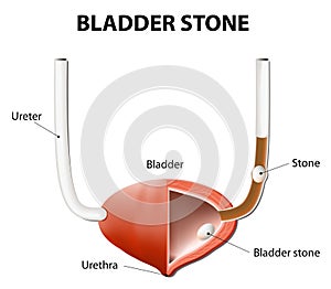 Stones in the urinary bladder and ureter