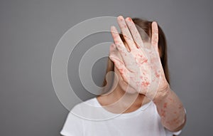 Stop Measles. Girl With Virus Closing Face Over Grey Background