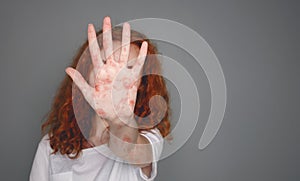 Stop Measles. Woman With Red Spots Over Grey Background