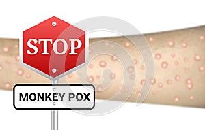 Stop monkey pox sigh board on blur infected hand