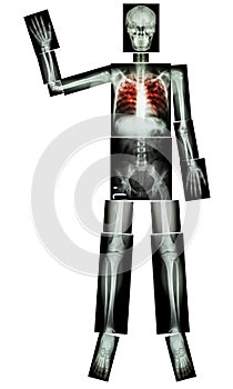 Stop TB(Tuberculosis) (Human bone raise hand) (Whole body :head skull neck spine shoulder arm elbow forearm wrist hand finger tho