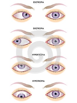 Strabismus