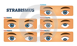 Strabismus or cross eyed vision condition, vector illustrations photo