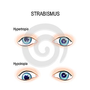Strabismus. crossed eyes