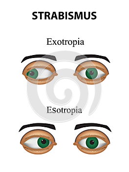 Strabismus. Esotropia. Exotropia. Infographics. Vector illustration on background.