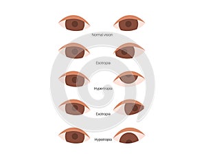 Strabismus eye disease photo