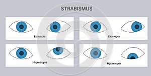 Strabismus eye disease photo