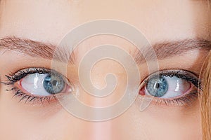 Strabismus Eye Surgery. Close up of crazy female eyes with squint. Eye muscle recession. Extraocular Muscle Anatomy. photo