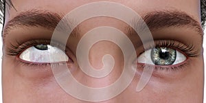 Strabismus, eyes deviation, illustration