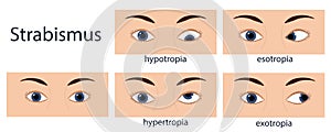 Strabismus flat style infographic set of stages: normal and disorders, european person.