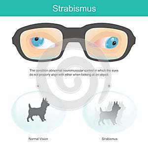 Strabismus. Meaning the condition abnormal neuromuscular control in which the eyes do not properly align with other when looking photo
