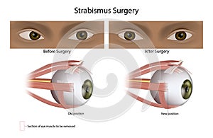 Strabismus or Squint surgery treats misaligned eyes. Eye Muscle Surgery.