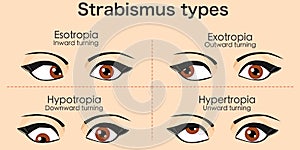 Strabismus types woman crossed eyes. Esotropia,  inward turning, Outward, exotropia, Upward hypertropia, Downward hypotropia, Skin