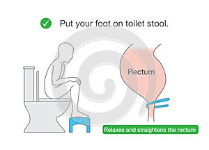 Straightens the rectum while sitting on toilet with small benches. photo