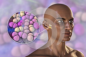 Streptococcus pneumoniae bacteria as a cause of sinusitis