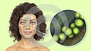 Streptococcus pyogenes bacteria and other streptococci as a cause of sinusitis