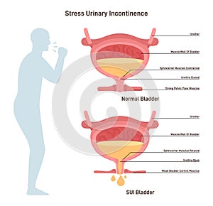 Stress urinary incontinence. Leakage of urine during moments of physical