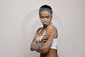 Stressed black woman scratching red spots on her skin