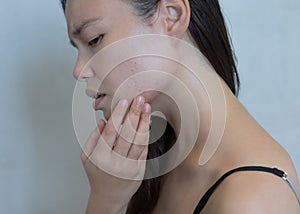 Stressed woman breaking out with acne on her face