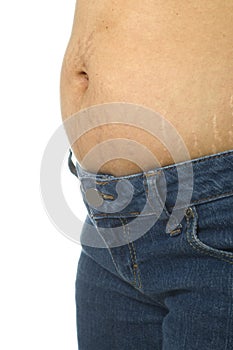 Stretch Mark