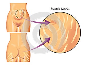 Stretch marks