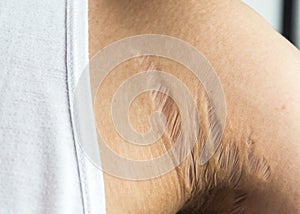 Stretch marks on armpit skin area caused by tearing of the dermis layer of the skin prednisolone`s side effect photo