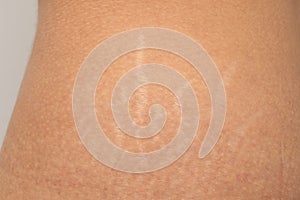 Stretch marks on the body skin of female thighs
