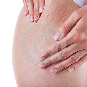 Stretch marks and cellulite