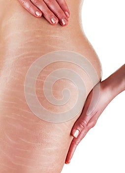 Stretch marks and cellulite photo