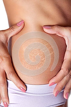 Stretch marks on female skin