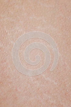 Stretch marks on human skin